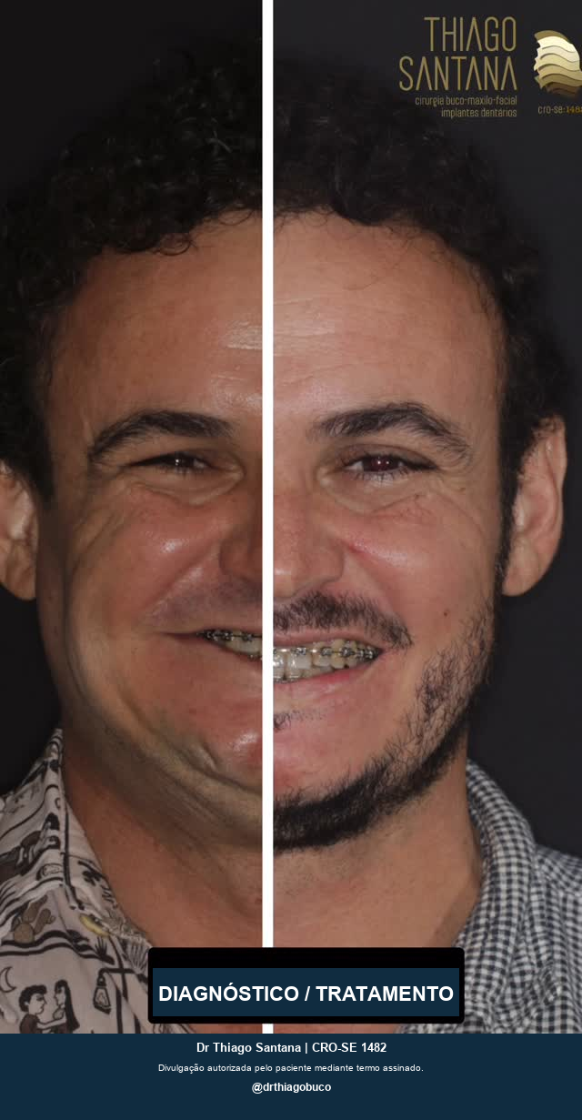 Júlio: Registros de diagnóstico e evolução do tratamento da assimetria facial.