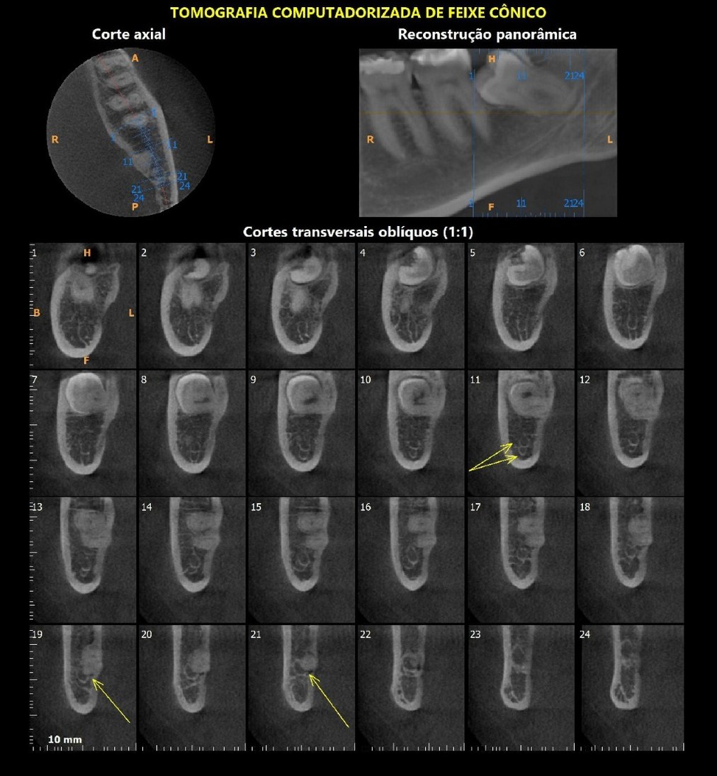Tomografia do mesmo caso de sisos: cortes da região dos molares inferiores e do canal mandibular